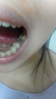 成人可以拔下门牙吗视频,安全与恢复指南